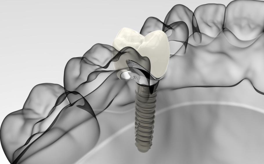 how-dental-implants-work
