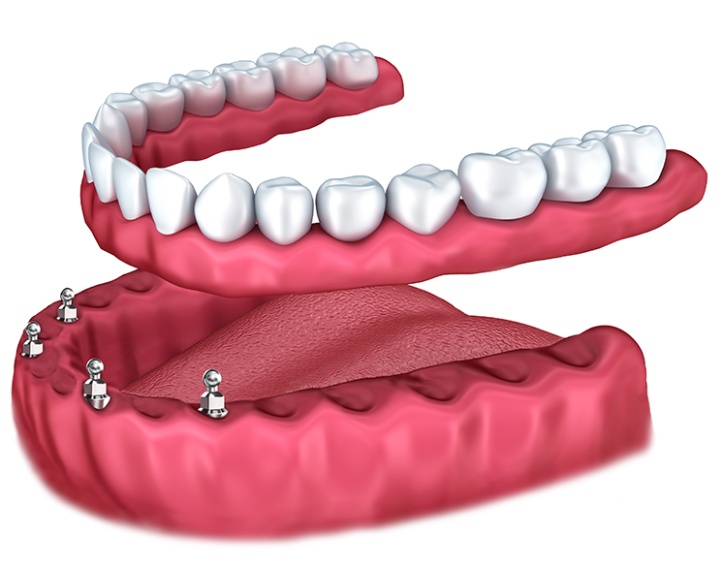 Overdentures